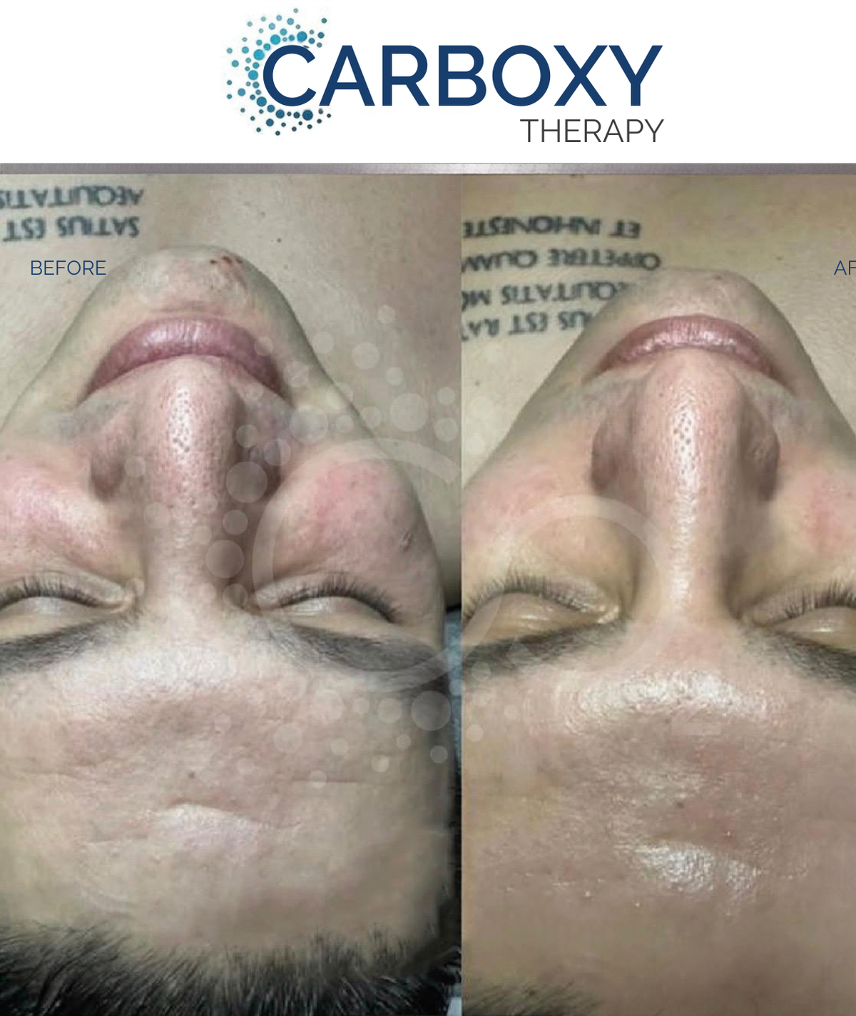 (New) Spalina CO2 Plasma Renewal Facial Series