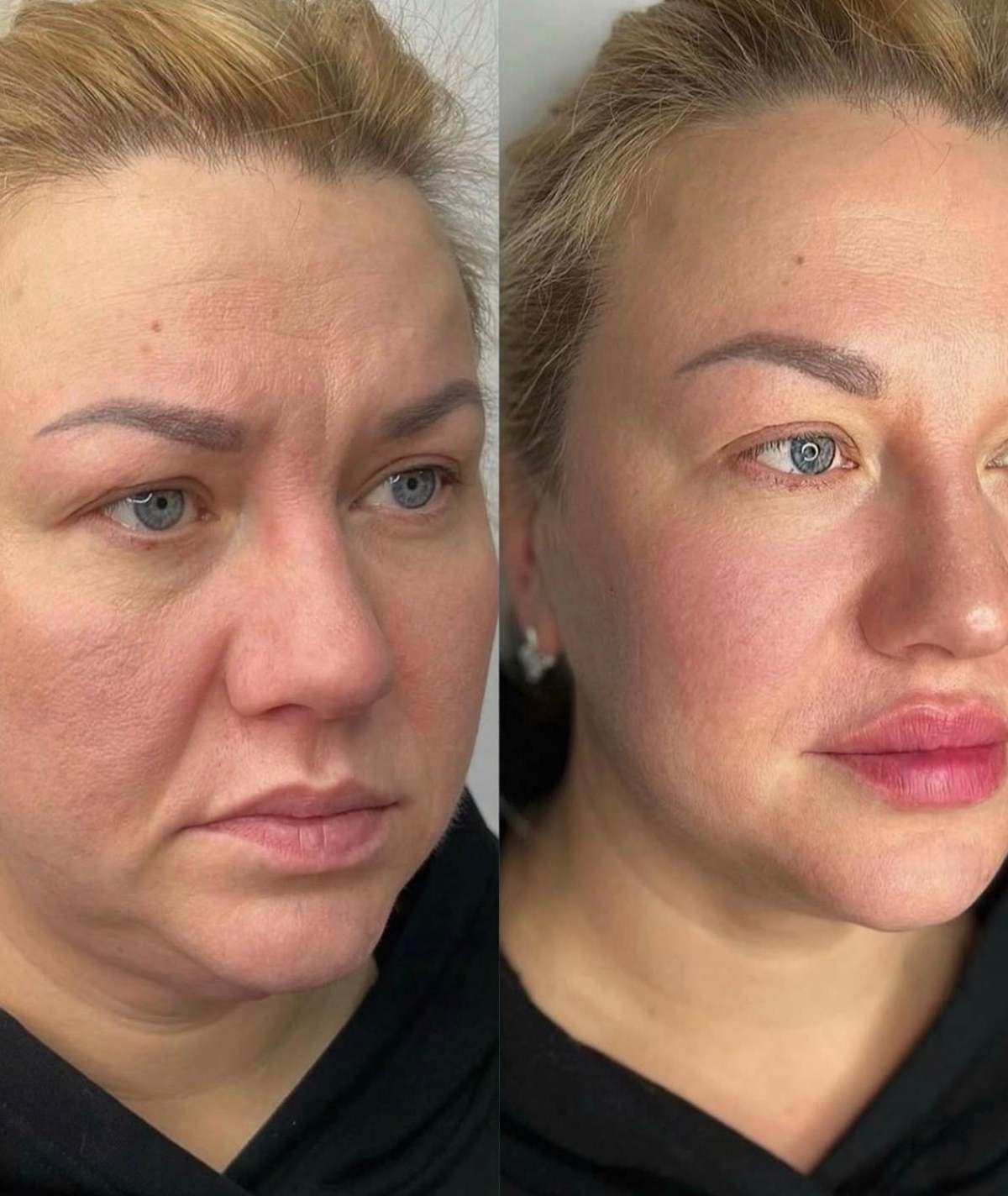 (New) Spalina CO2 Plasma Renewal Facial Series